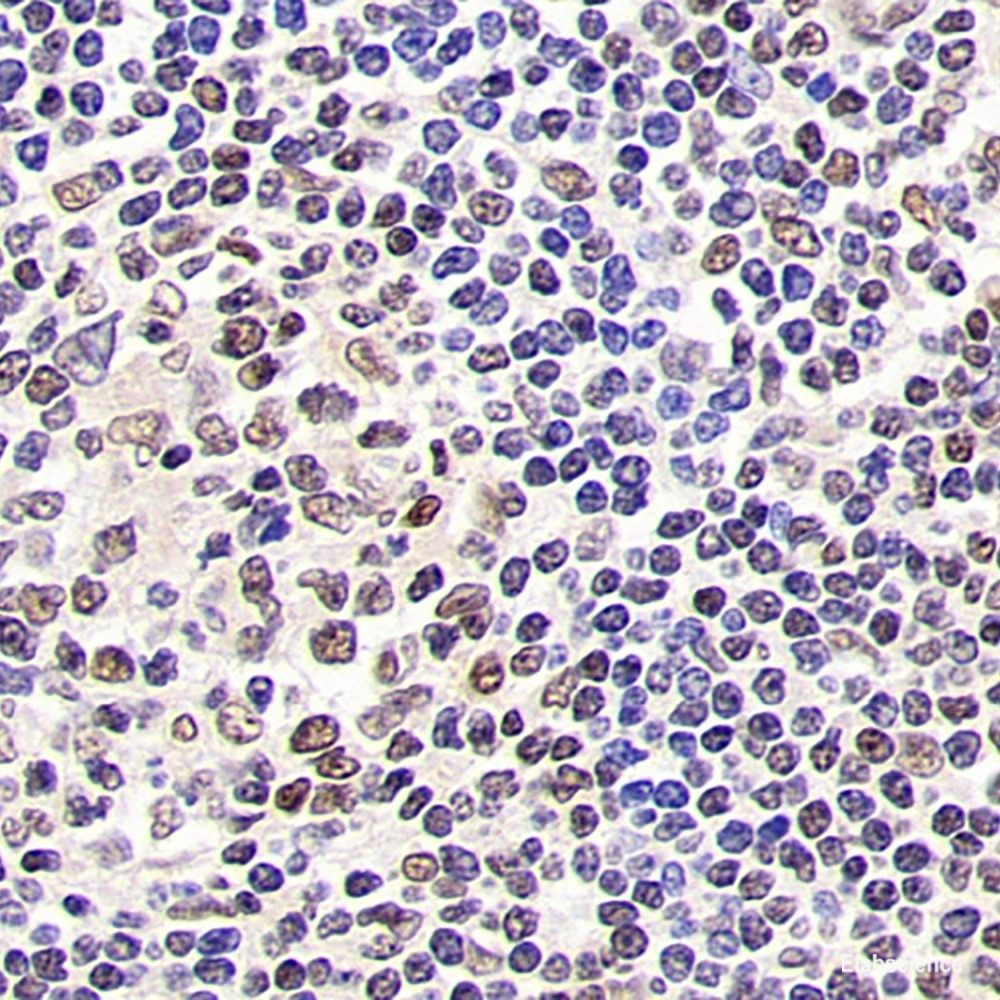 Immunohistochemistry analysis of paraffin-embedded human lung cancer using BSG Polyclonal Antibody at dilution of 1:200.