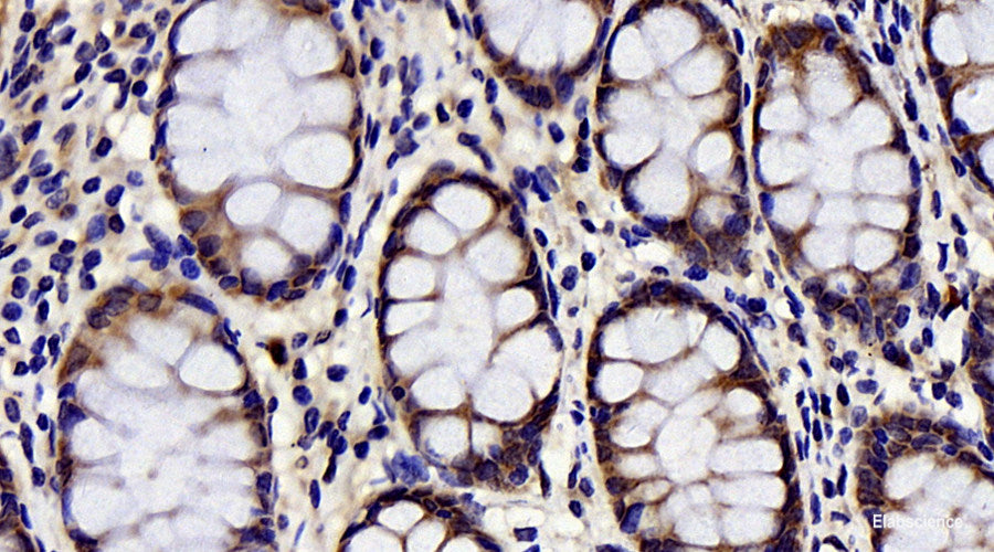 Immunohistochemistry analysis of paraffin-embedded human colon using BAD Polyclonal Antibody at dilution of 1:300.