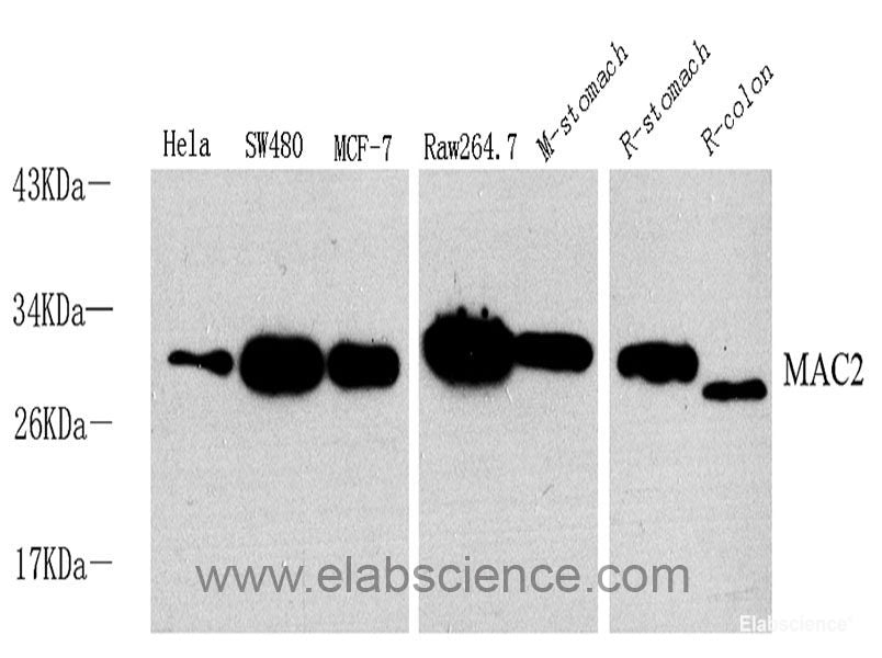 Immunohistochemistry analysis of paraffin-embedded human stomach cancer using HSPA5 Polyclonal Antibody at dilution of 1:300.