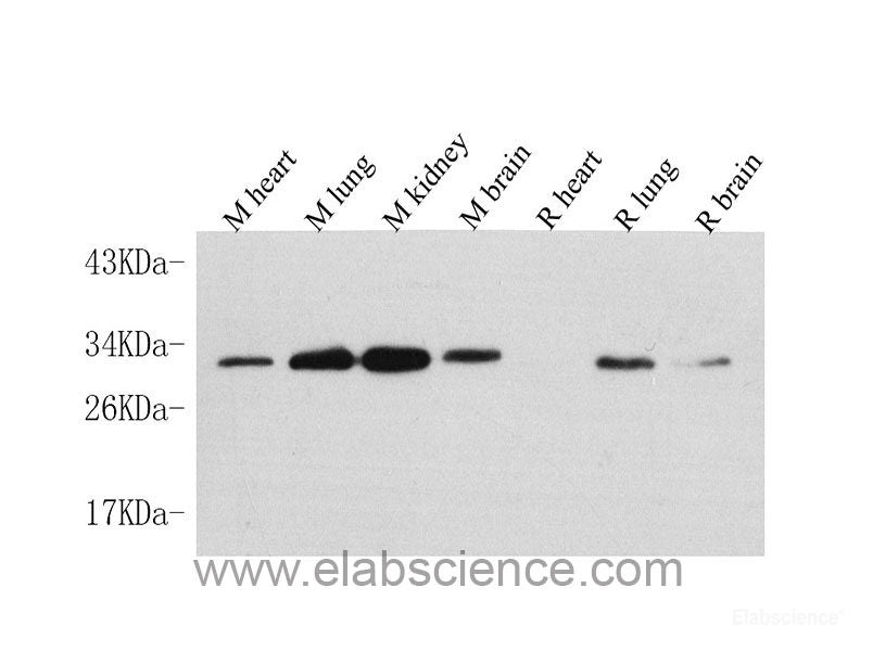 Immunohistochemistry analysis of paraffin-embedded human stomach cancer using CDK4 Polyclonal Antibody at dilution of 1:100.