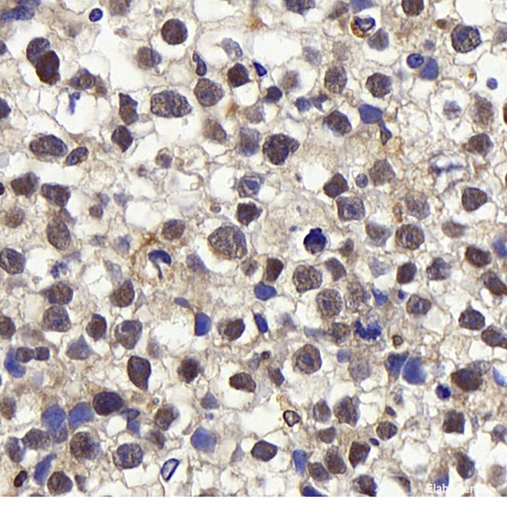 Immunohistochemistry analysis of paraffin-embedded human lung cancer using HDAC2 Polyclonal Antibody at dilution of 1:1000.