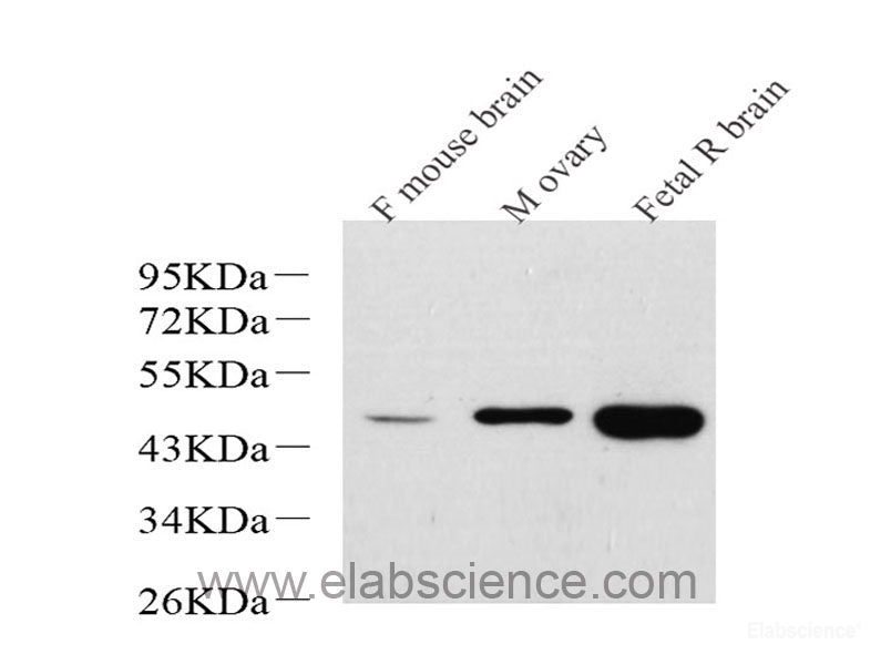 Immunohistochemistry analysis of paraffin-embedded human endometrial cancer using PGR Polyclonal Antibody at dilution of 1:300.