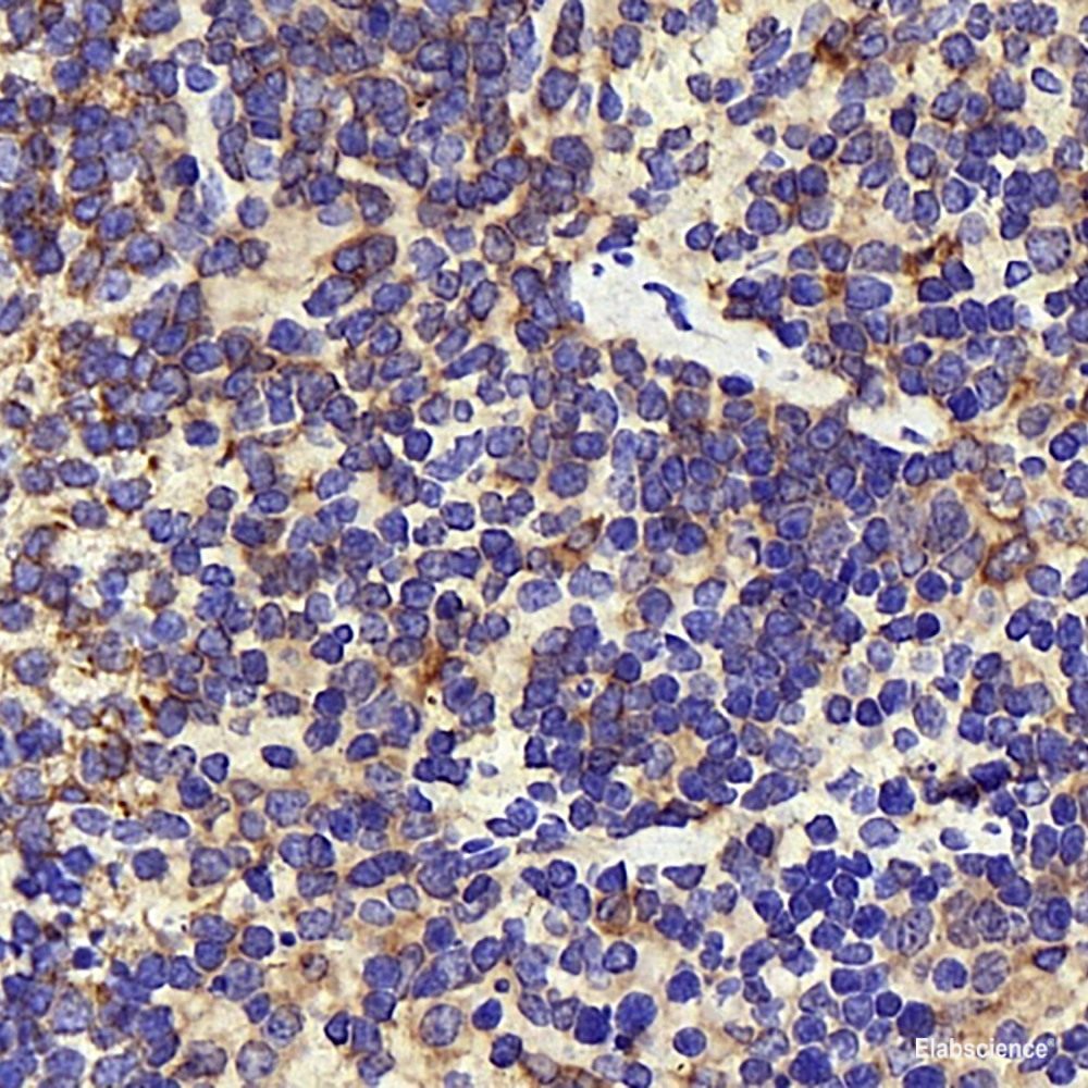 Immunohistochemistry analysis of paraffin-embedded human lung cancer using IkB alpha Polyclonal Antibody at dilution of 1:500.
