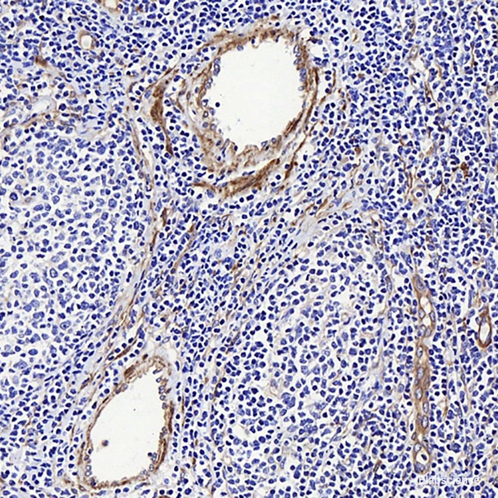 Immunohistochemistry analysis of paraffin-embedded human stomach cancer using MMP9 Polyclonal Antibody at dilution of 1:200.