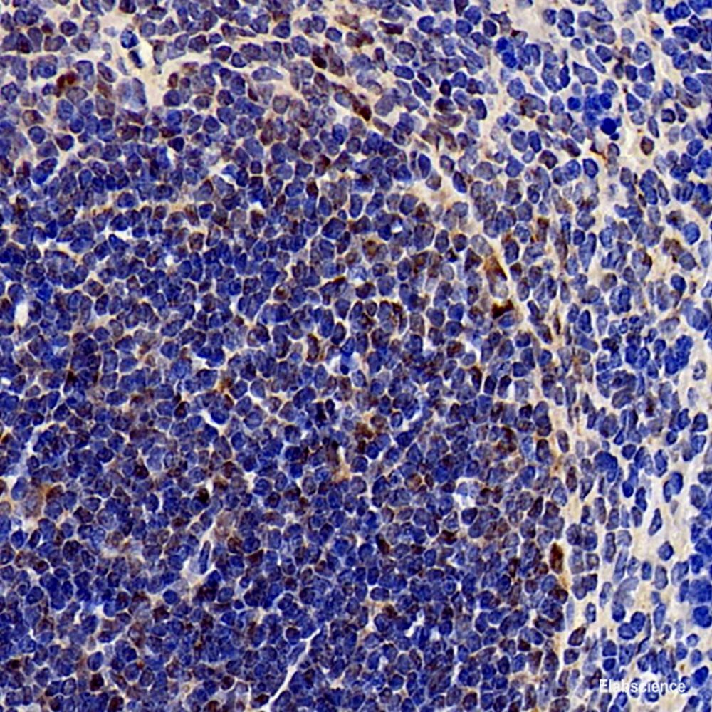 Immunohistochemistry analysis of paraffin-embedded human lung cancer using ATF6 Polyclonal Antibody at dilution of 1:400.
