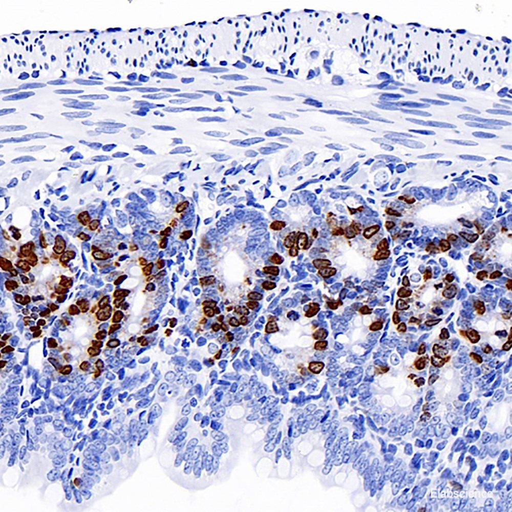 Immunohistochemistry analysis of paraffin-embedded human Lymphoma using LDLR Polyclonal Antibody at dilution of 1:300.