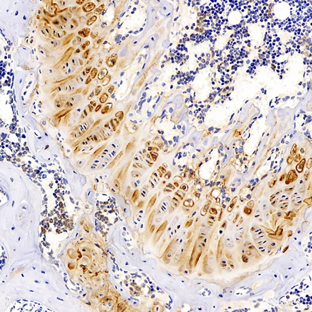 mmunohistochemistry analysis of paraffin-embedded human stomach cancer using ENO2 Polyclonal Antibody at dilution of 1:300.