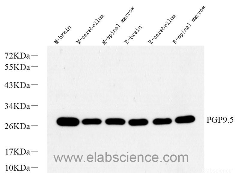 Immunohistochemistry analysis of paraffin-embedded human breast cancer using ATG7 Polyclonal Antibody at dilution of 1:400.
