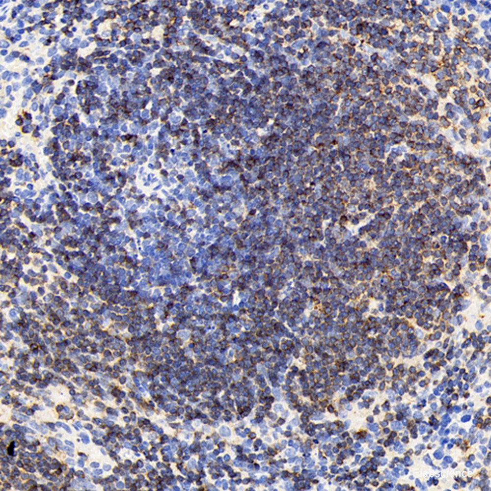 Immunohistochemistry analysis of paraffin-embedded human liver cancer using ATG5 Polyclonal Antibody at dilution of 1:400.