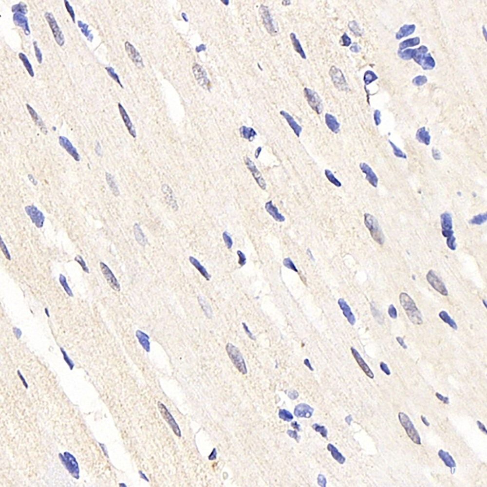 Immunohistochemistry analysis of paraffin-embedded human liver cancer using IGF1 Polyclonal Antibody at dilution of 1:500.
