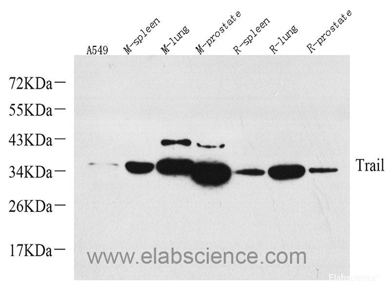 Immunohistochemistry of paraffin-embedded Human lung cancer using c-Fos Polyclonal Antibody at dilution of 1:150 (40x lens).