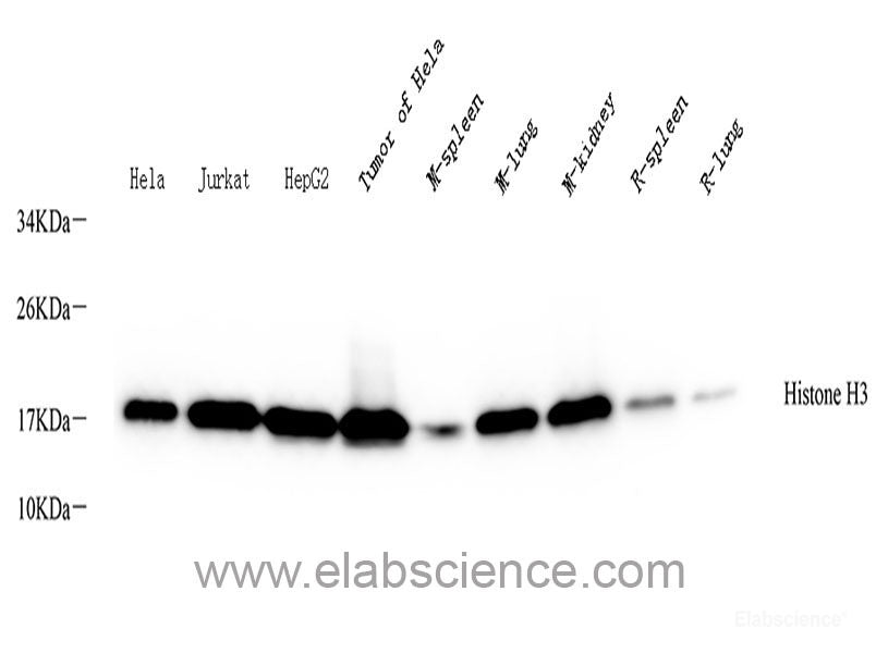 Immunohistochemistry of paraffin-embedded Human breast cancer using NEFL Polyclonal Antibody at dilution of 1:200 (40x lens).