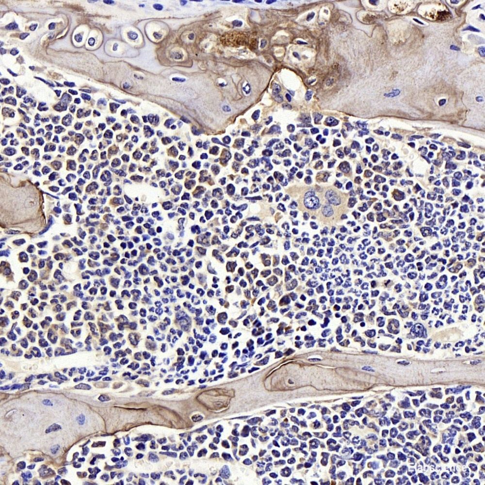 Immunohistochemistry of paraffin-embedded Human liver cancer using Cyclin D1 Polyclonal Antibody at dilution of 1:100 (40x lens).