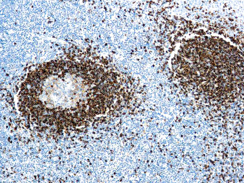 Hairy Cell Leukemia
