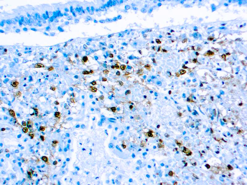 Herpes Simplex Virus II (HSV II)