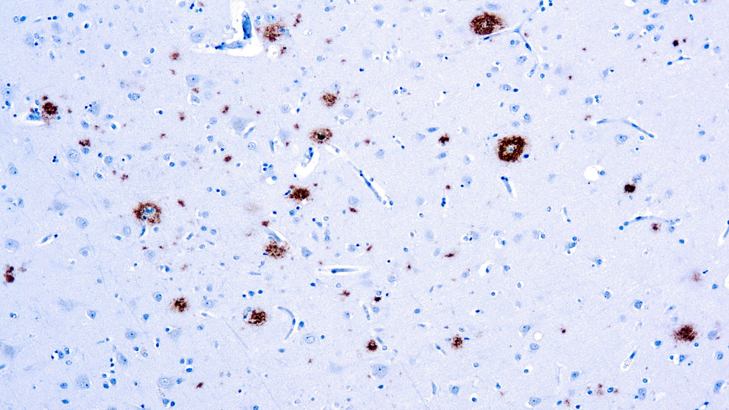 Amyloid Beta Protein