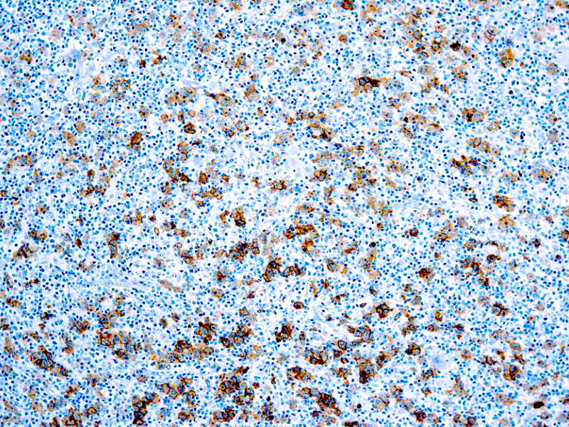 CD30 Ki-1 Antigen