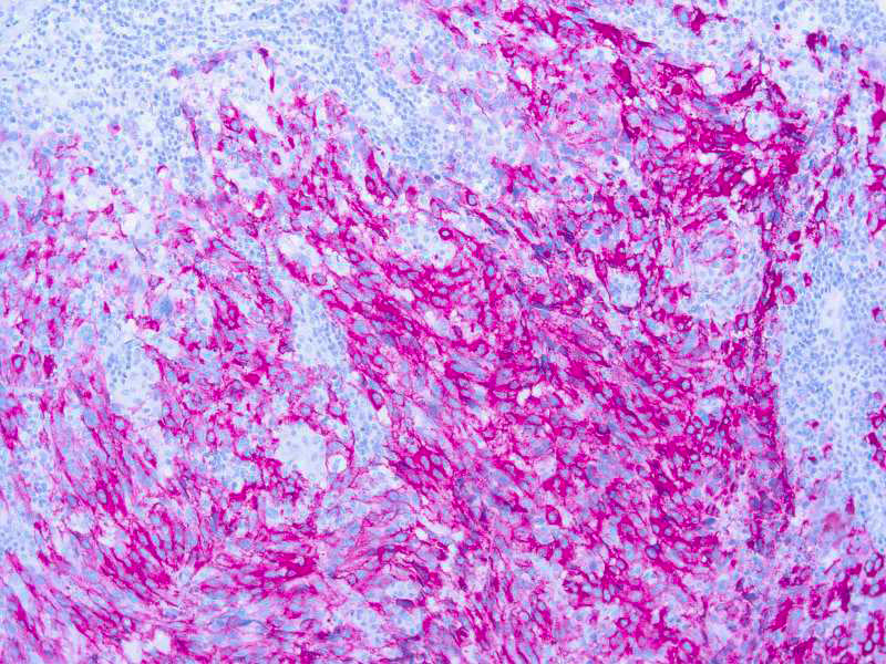 Melanoma