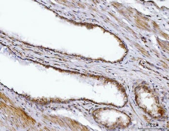 IHC staining of FFPE human prostate cancer tissue with BBS9 antibody. HIER: boil tissue sections in pH8 EDTA for 20 min and allow to cool before testing.