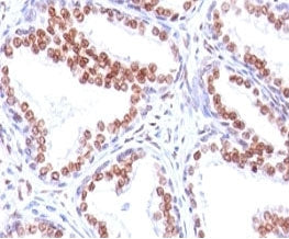 IHC: Formalin-fixed, paraffin-embedded human prostate carcinoma stained with anti-Androgen Receptor 