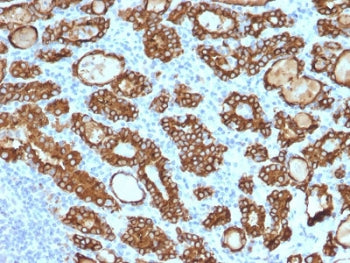IHC testing of FFPE human thyroid carcinoma stained with Thyroid Peroxidase antibody (clone TPO/1922