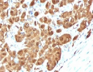 IHC testing of FFPE human melanoma with S100B antibody (clone PS1B1-1). Required HIER: boil tissue s