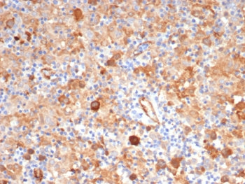 IHC staining of FFPE human Hodgkin's lymphoma tissue with Fascin 1 antibody (clone FSCN1/7207) at 2u