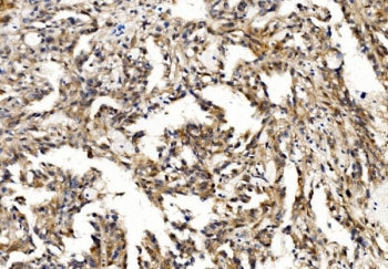 IHC staining of FFPE human renal cancer with PFN2 antibody. HIER: boil tissue sections in pH8 EDTA f