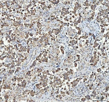 IHC staining of FFPE human testicular germ cell tumor tissue with MYCBP antibody. HIER: boil tissue 