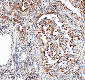 IHC staining of FFPE human lung adenocarcinoma tissue with CDH5 antibody. HIER: boil tissue sections