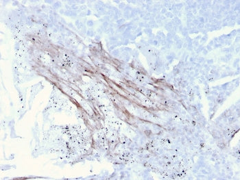 IHC staining of FFPE human lung carcinoma with Tenascin C antibody (clone rTNC/3635). HIER: boil tis
