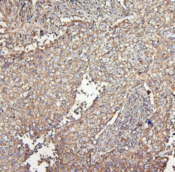 IHC staining of FFPE human lung cancer with MVP antibody. HIER: boil tissue sections in pH6, 10mM ci