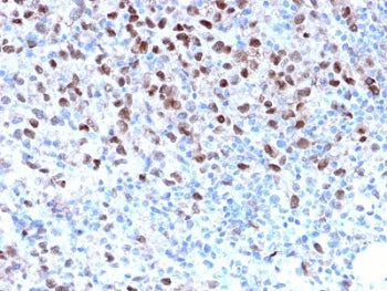 IHC staining of FFPE human melanoma with recombinant MITF antibody. HIER: boil tissue sections in pH