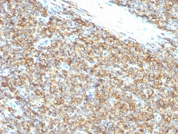 IHC: Formalin-fixed, paraffin-embedded human Ewing's sarcoma stained with CD99 antibody (12E7). Requ
