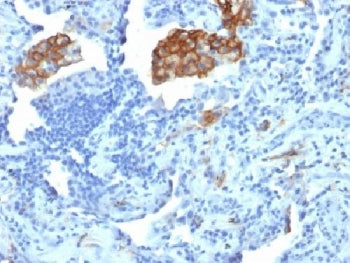 IHC testing of FFPE human lung carcinoma with DC-SIGN antibody (clone C209/1781). Required HIER: boi