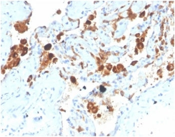 IHC staining of FFPE human lung tissue with Surfactant Protein D antibody (clone SFTPD/4363). HIER: 