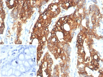 IHC staining of FFPE human colon carcinoma tissue with S100A14 antibody (clone S100A14/7401). Inset: