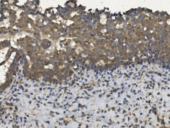 IHC staining of FFPE human breast cancer with EIF2AK4 antibody. HIER: boil tissue sections in pH8 ED