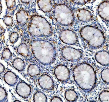IHC staining of FFPE human colon cancer tissue with GALT antibody. HIER: boil tissue sections in pH8