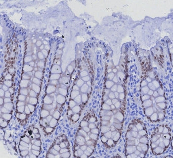 IHC staining of FFPE human colon carcinoma tissue with SATB2 antibody (clone SATB2/7488) at 2ug/ml. 