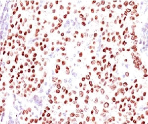 IHC testing of FFPE human breast carcinoma with Progesterone Receptor antibody (clone PGSR17). Requi