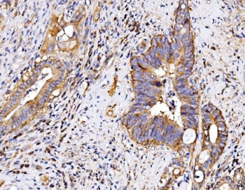 IHC staining of FFPE human gall bladder adenosquamous carcinoma tissue with P2X7 antibody. HIER: boi