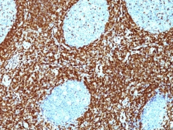 IHC: Formalin-fixed, paraffin-embedded human non-Hodgkin's lymphoma stained with Bcl-2 antibody (BCL