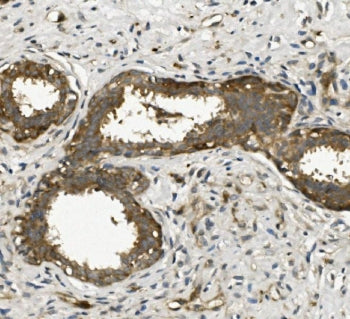 IHC staining of FFPE human breast cancer with ACTR2 antibody. HIER: boil tissue sections in pH8 EDTA