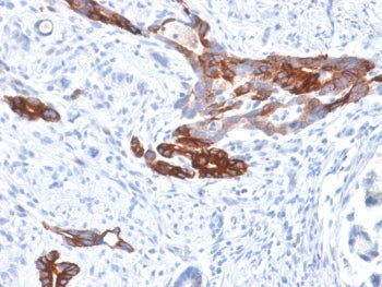IHC staining of FFPE human gastric carcinoma with recombinant Gastric Mucin antibody (clone MUC6/155