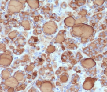 IHC staining of FFPE human thyroid carcinoma with recombinant Thyroglobulin antibody (clone TG157-3R
