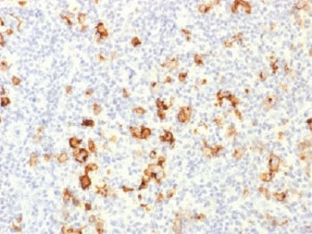 IHC testing of FFPE human Hodgkin's lymphoma with CD15 antibody. Required HIER: boil tissue sections