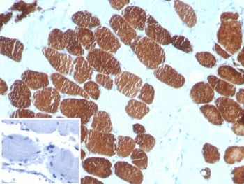 IHC staining of FFPE human breast carcinoma tissue with Myosin 7 antibody (clone MYH7/727). Inset: P