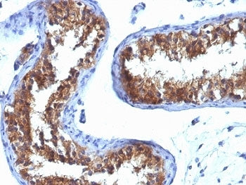IHC analysis of formalin-fixed, paraffin-embedded human testicular carcinoma stained with Major Vaul