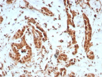 IHC staining of FFPE human breast carcinoma tissue with BRCA1-Associated Protein 1 antibody (clone B